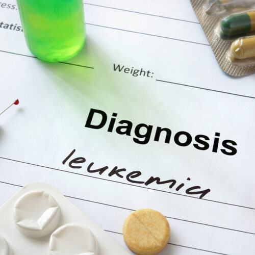 Acute Myeloid Leukemia – Stages, Types, Symptoms, Causes, and Therapies