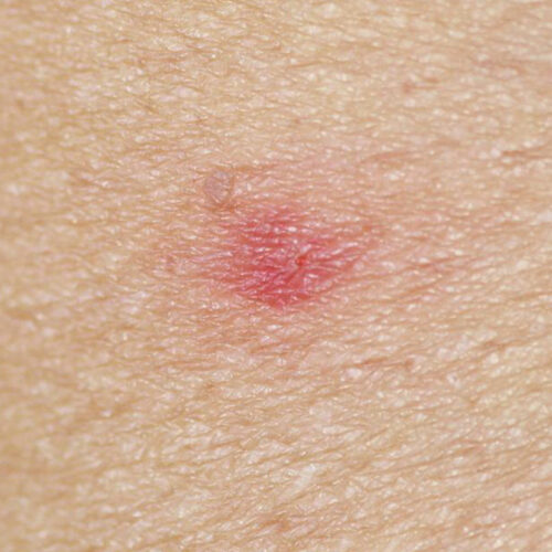 How to identify a bug bite