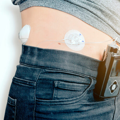Insulin pumps – 3 best devices to buy in 2021