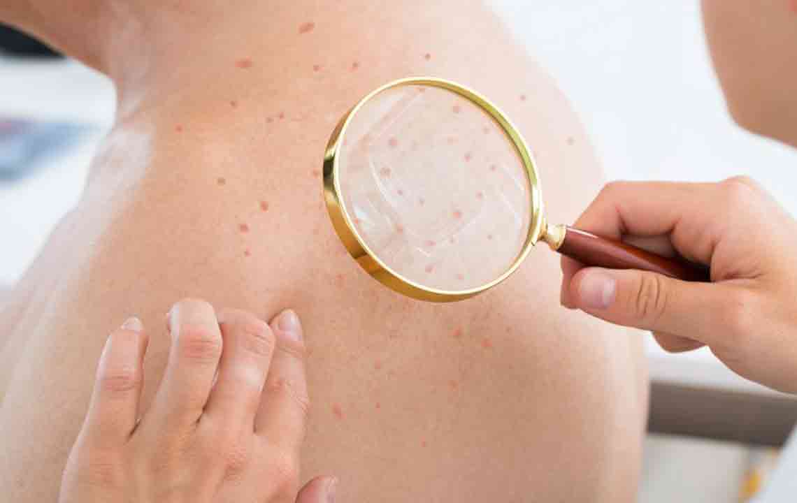 Atopic Dermatitis Eczema – Causes, Symptoms, and Treatments