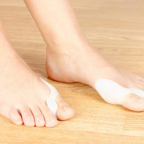 Bunion Treatment – All You Need to Know