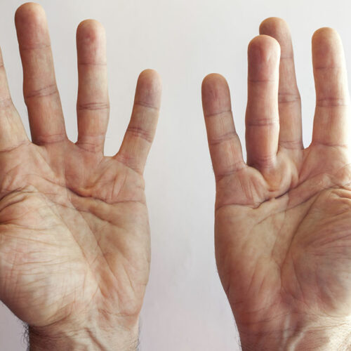 Dupuytren’s Contracture – Its Symptoms and Causes