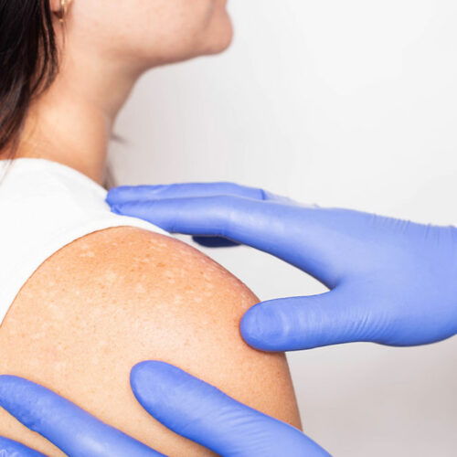 Vitiligo – Signs, Causes, and Management Remedies